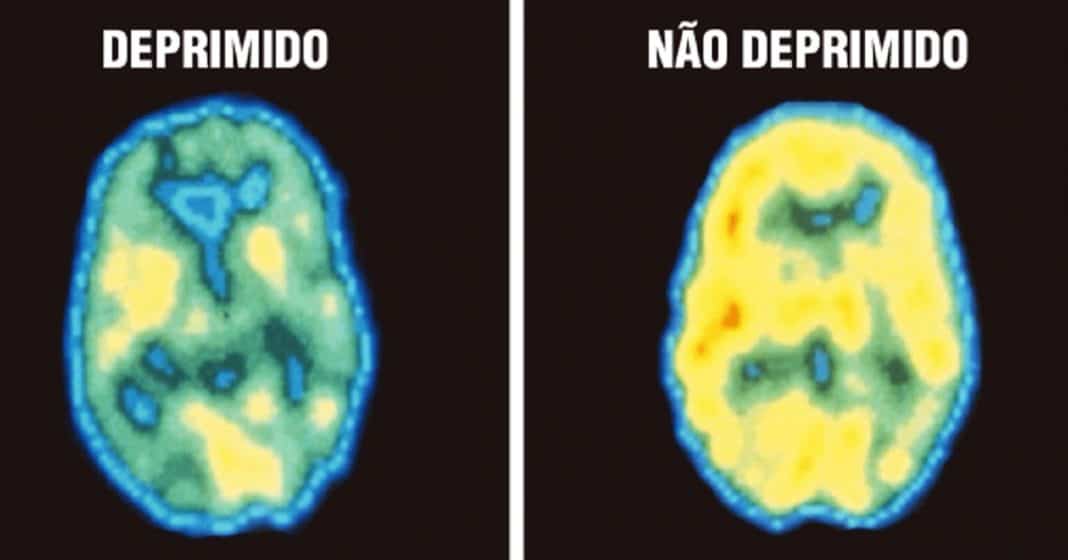 Nova Pesquisa Diz Que A Depressão Não É Uma Escolha, É Uma Forma De Dano Cerebral