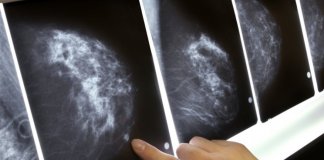 Adeus mamografia: Um novo exame de sangue que detectaria precocemente o câncer de mama
