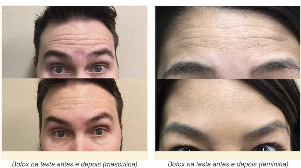 fasdapsicanalise.com.br - Revelando a verdade por tr&aacute;s do Botox na testa: desmascarando mitos e explorando benef&iacute;cios